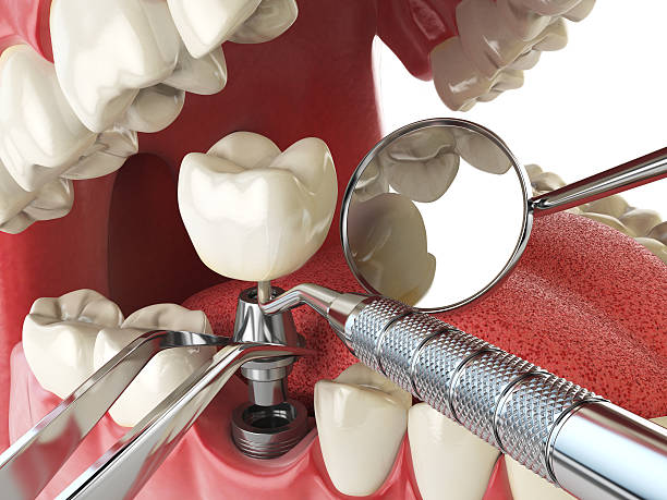 Best Emergency Broken Tooth Repair in Akron, OH